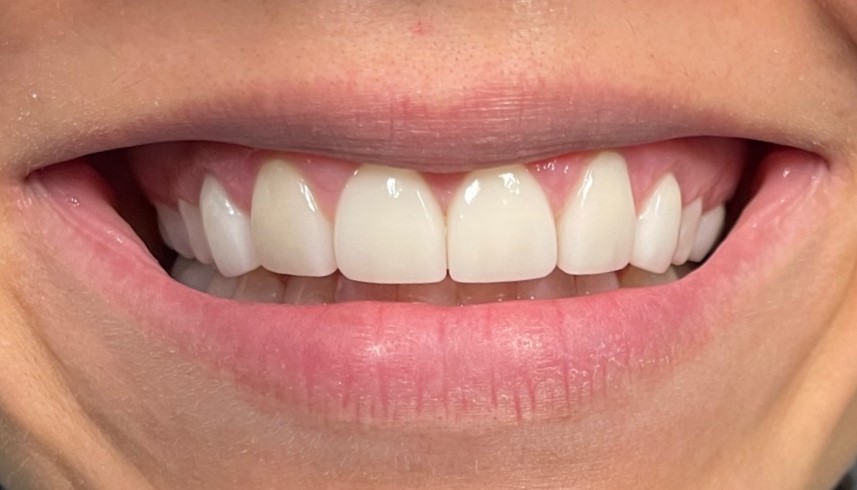 After dental treatment at Smile Innovations