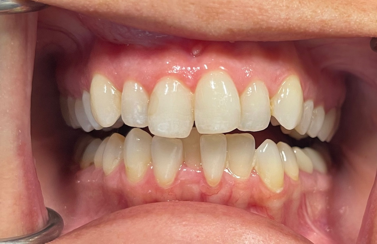 Before dental treatment at Smile Innovations