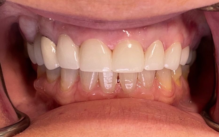 After dental treatment at Smile Innovations